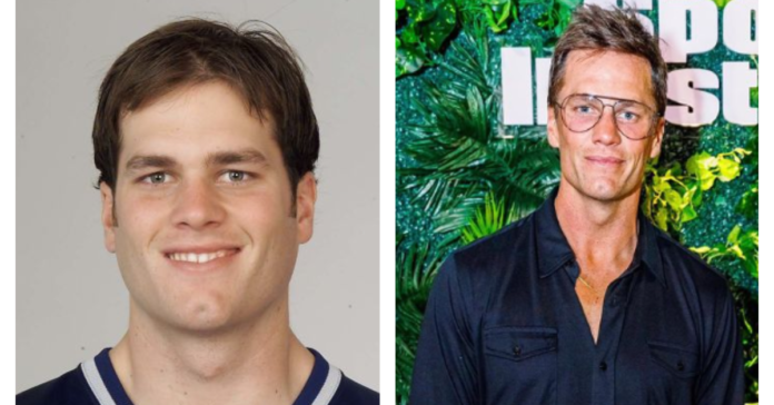 Tom Brady Plastic Surgery