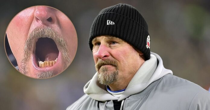 Dan Campbell False Teeth