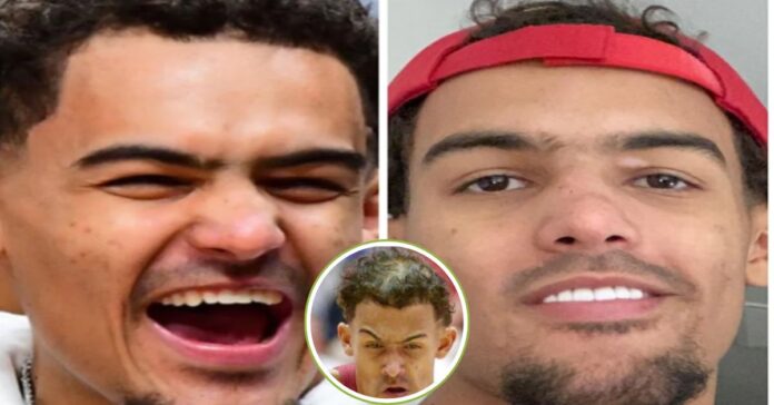 Trae Young Teeth